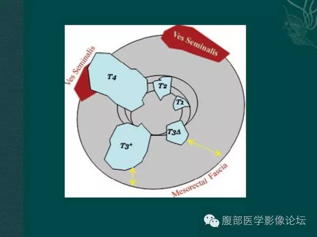 【PPT】直肠癌MRI分期
