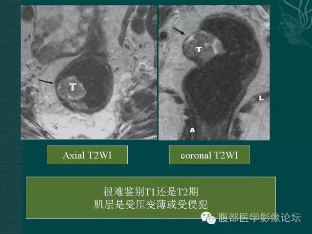 【PPT】直肠癌MRI分期
