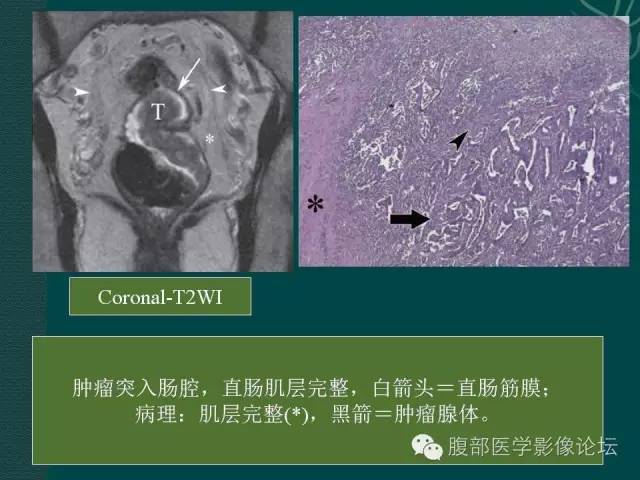 【PPT】直肠癌MRI分期
