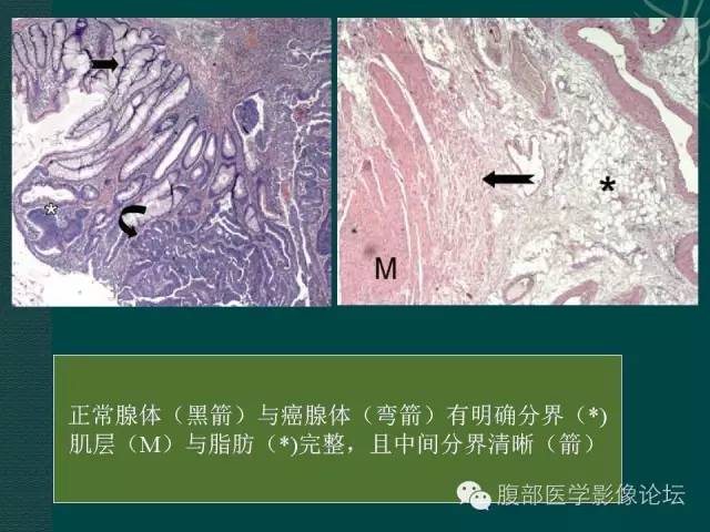 【PPT】直肠癌MRI分期