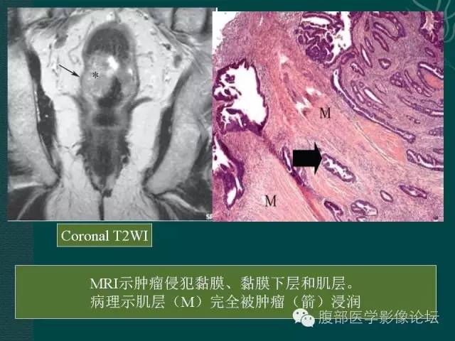 【PPT】直肠癌MRI分期