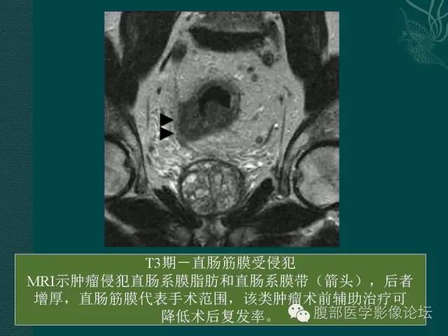 【PPT】直肠癌MRI分期