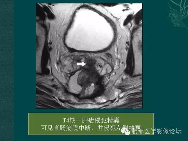 【PPT】直肠癌MRI分期