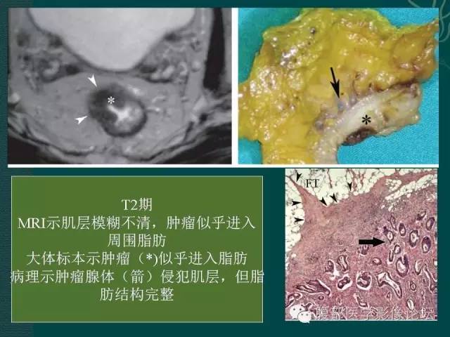 【PPT】直肠癌MRI分期