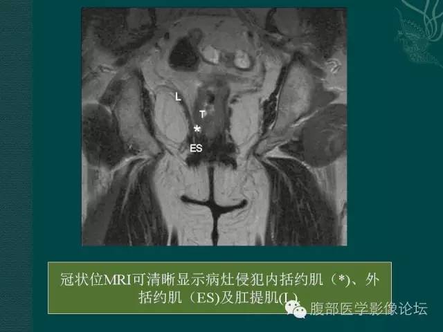【PPT】直肠癌MRI分期