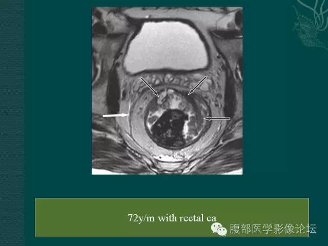 【PPT】直肠癌MRI分期