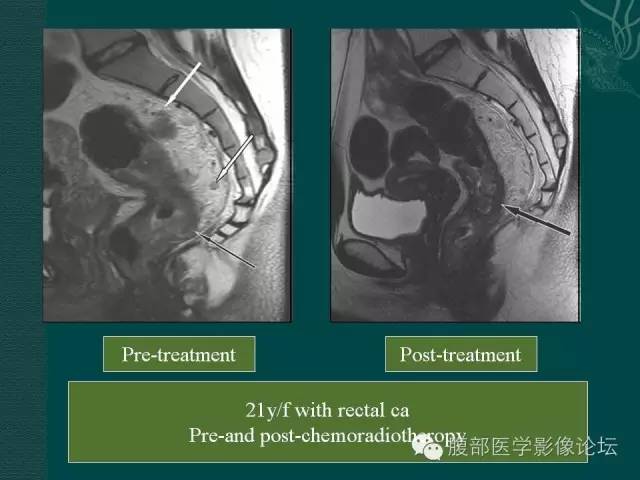 【PPT】直肠癌MRI分期