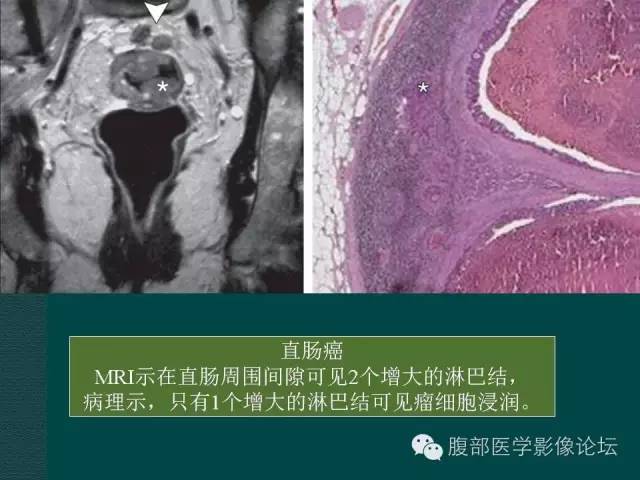 【PPT】直肠癌MRI分期