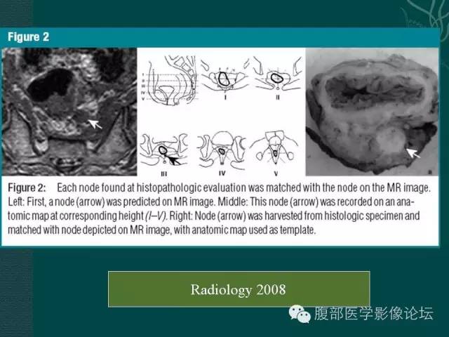 【PPT】直肠癌MRI分期