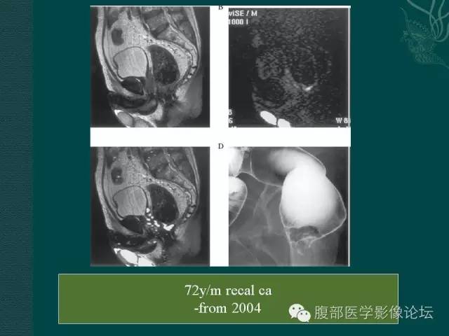 【PPT】直肠癌MRI分期