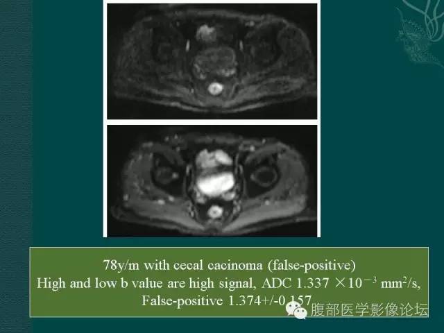 【PPT】直肠癌MRI分期