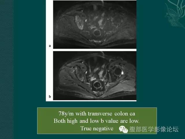 【PPT】直肠癌MRI分期