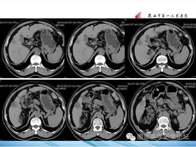 【病例】孤立性肝脏坏死结节1例CT影像表现 【病例】孤立性肝脏坏死结节1例CT影像表现