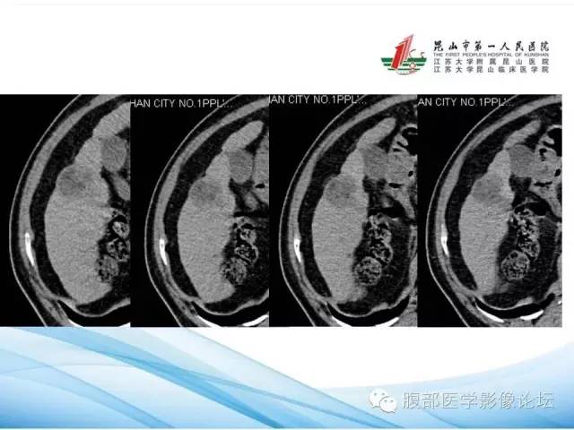 【病例】孤立性肝脏坏死结节1例CT影像表现 【病例】孤立性肝脏坏死结节1例CT影像表现