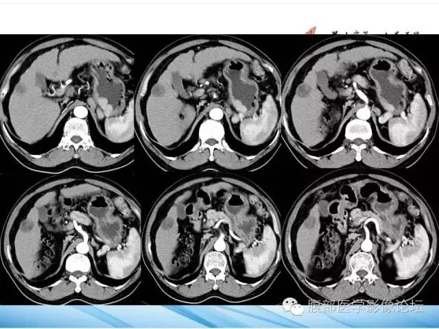 【病例】孤立性肝脏坏死结节1例CT影像表现 【病例】孤立性肝脏坏死结节1例CT影像表现