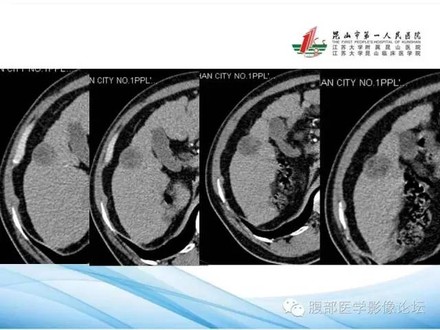 【病例】孤立性肝脏坏死结节1例CT影像表现 【病例】孤立性肝脏坏死结节1例CT影像表现