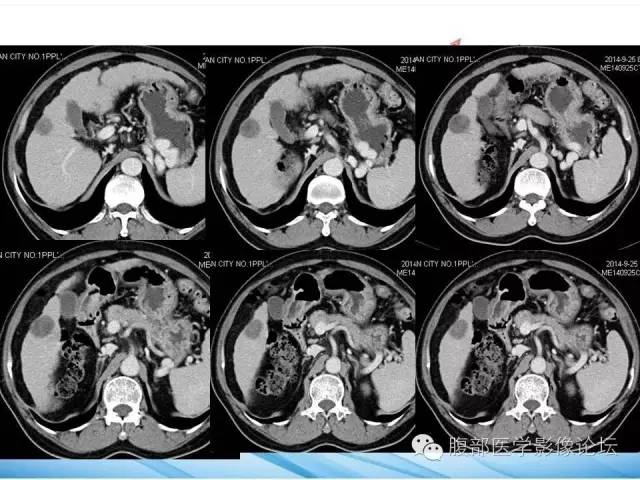 【病例】孤立性肝脏坏死结节1例CT影像表现 【病例】孤立性肝脏坏死结节1例CT影像表现