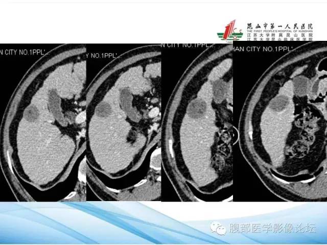 【病例】孤立性肝脏坏死结节1例CT影像表现 【病例】孤立性肝脏坏死结节1例CT影像表现