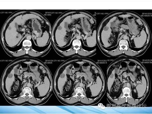 【病例】孤立性肝脏坏死结节1例CT影像表现 【病例】孤立性肝脏坏死结节1例CT影像表现