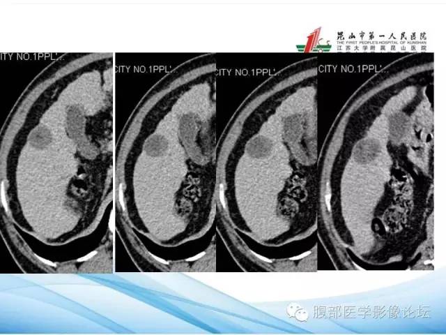 【病例】孤立性肝脏坏死结节1例CT影像表现 【病例】孤立性肝脏坏死结节1例CT影像表现