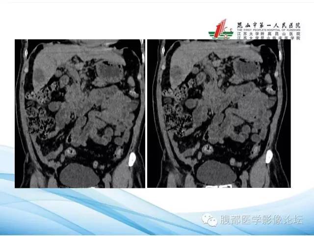 【病例】孤立性肝脏坏死结节1例CT影像表现 【病例】孤立性肝脏坏死结节1例CT影像表现