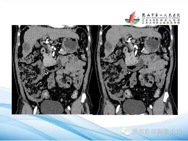 【病例】孤立性肝脏坏死结节1例CT影像表现 【病例】孤立性肝脏坏死结节1例CT影像表现