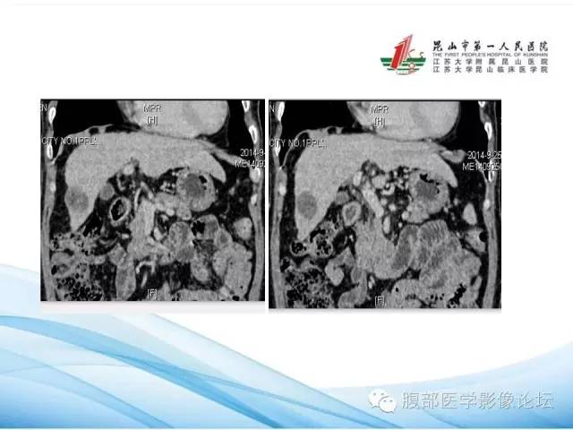 【病例】孤立性肝脏坏死结节1例CT影像表现 【病例】孤立性肝脏坏死结节1例CT影像表现