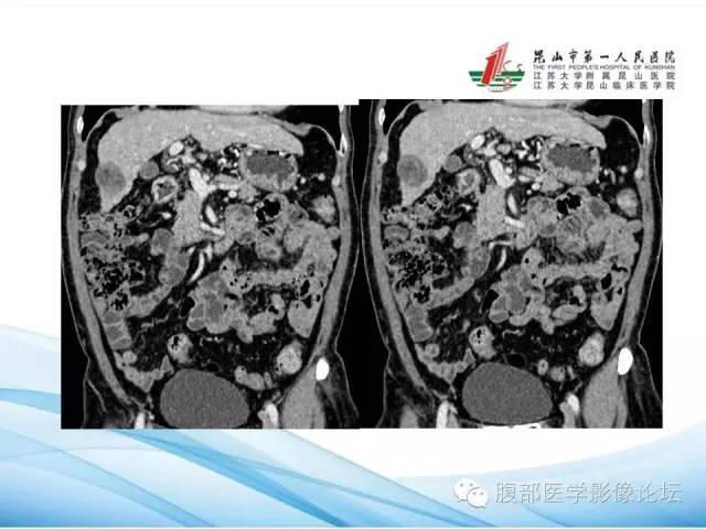 【病例】孤立性肝脏坏死结节1例CT影像表现 【病例】孤立性肝脏坏死结节1例CT影像表现