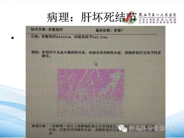【病例】孤立性肝脏坏死结节1例CT影像表现 【病例】孤立性肝脏坏死结节1例CT影像表现