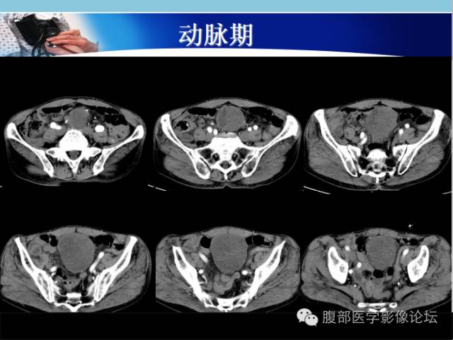 【病例】肠系膜脂肪肉瘤1例CT 【病例】肠系膜脂肪肉瘤1例CT
