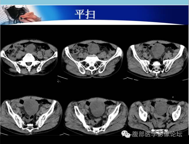 【病例】肠系膜脂肪肉瘤1例CT 【病例】肠系膜脂肪肉瘤1例CT