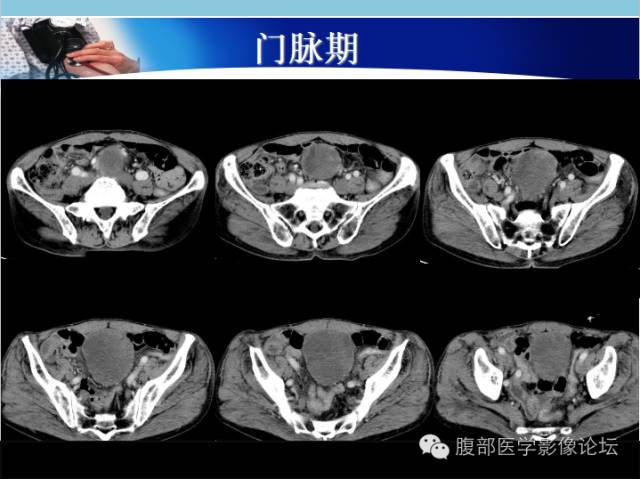 【病例】肠系膜脂肪肉瘤1例CT 【病例】肠系膜脂肪肉瘤1例CT