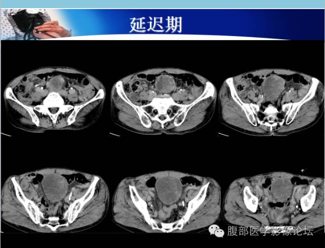 【病例】肠系膜脂肪肉瘤1例CT 【病例】肠系膜脂肪肉瘤1例CT