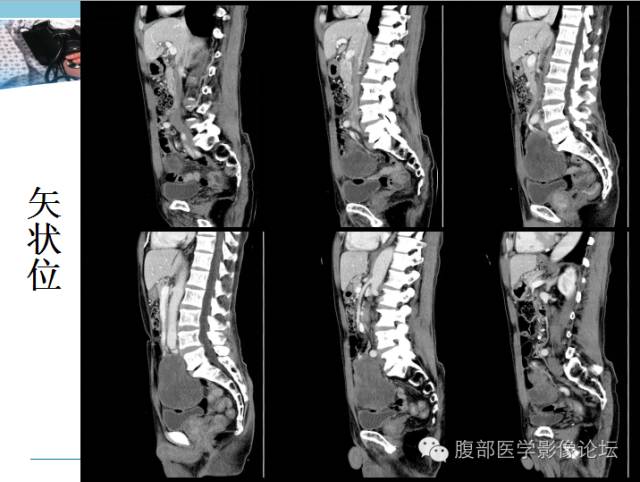【病例】肠系膜脂肪肉瘤1例CT 【病例】肠系膜脂肪肉瘤1例CT