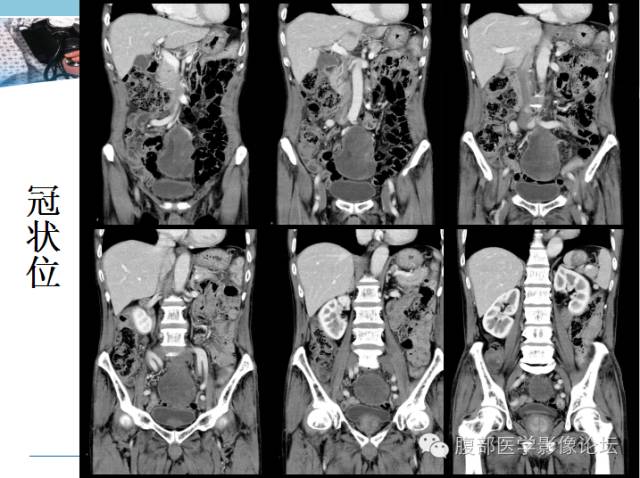 【病例】肠系膜脂肪肉瘤1例CT 【病例】肠系膜脂肪肉瘤1例CT