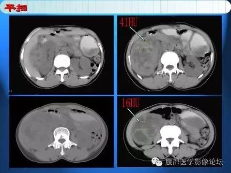 【病例】右肾上皮样血管平滑肌脂肪瘤1例 【病例】右肾上皮样血管平滑肌脂肪瘤1例