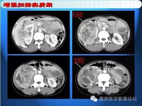【病例】右肾上皮样血管平滑肌脂肪瘤1例 【病例】右肾上皮样血管平滑肌脂肪瘤1例