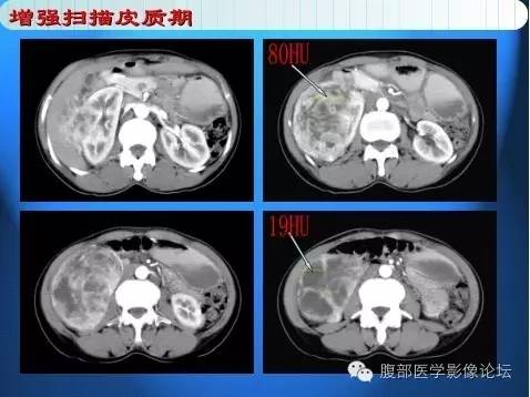 【病例】右肾上皮样血管平滑肌脂肪瘤1例 【病例】右肾上皮样血管平滑肌脂肪瘤1例