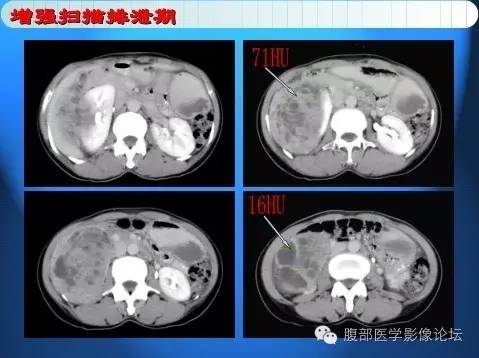 【病例】右肾上皮样血管平滑肌脂肪瘤1例 【病例】右肾上皮样血管平滑肌脂肪瘤1例