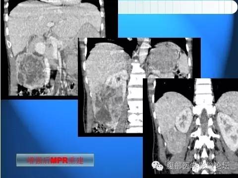 【病例】右肾上皮样血管平滑肌脂肪瘤1例 【病例】右肾上皮样血管平滑肌脂肪瘤1例