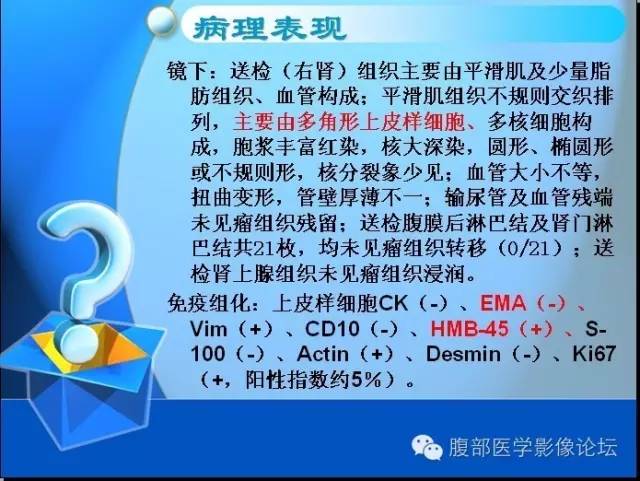 【病例】右肾上皮样血管平滑肌脂肪瘤1例 【病例】右肾上皮样血管平滑肌脂肪瘤1例