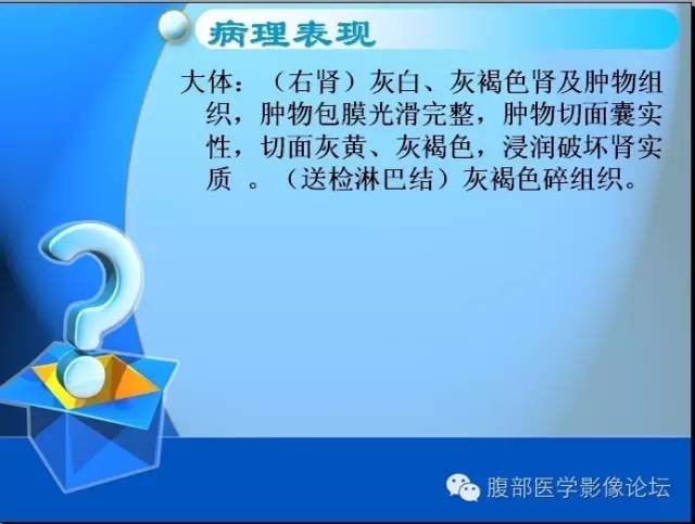 【病例】右肾上皮样血管平滑肌脂肪瘤1例 【病例】右肾上皮样血管平滑肌脂肪瘤1例