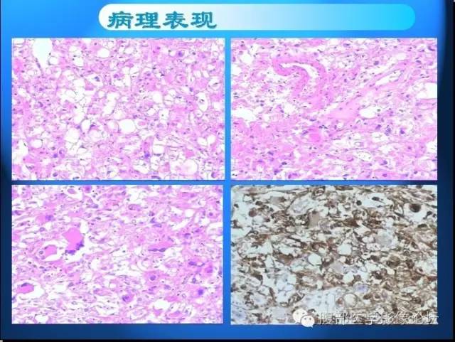 【病例】右肾上皮样血管平滑肌脂肪瘤1例 【病例】右肾上皮样血管平滑肌脂肪瘤1例