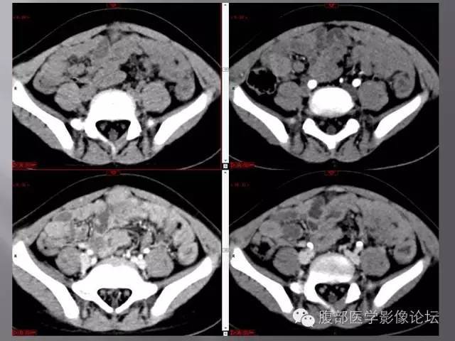 【病例】下腹部横纹肌肉瘤1例CT 【病例】下腹部横纹肌肉瘤1例CT