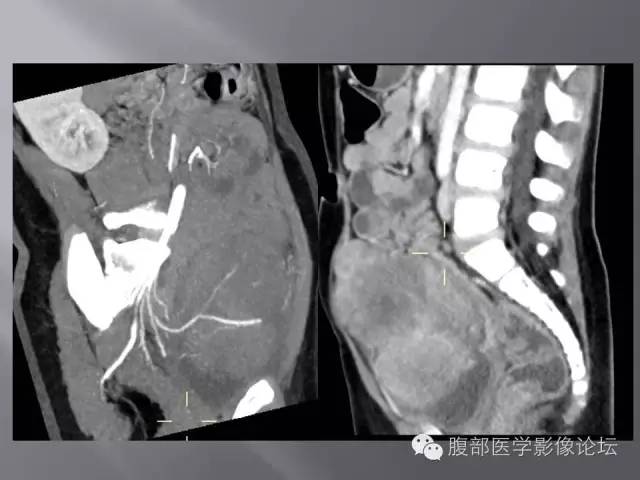 【病例】下腹部横纹肌肉瘤1例CT 【病例】下腹部横纹肌肉瘤1例CT