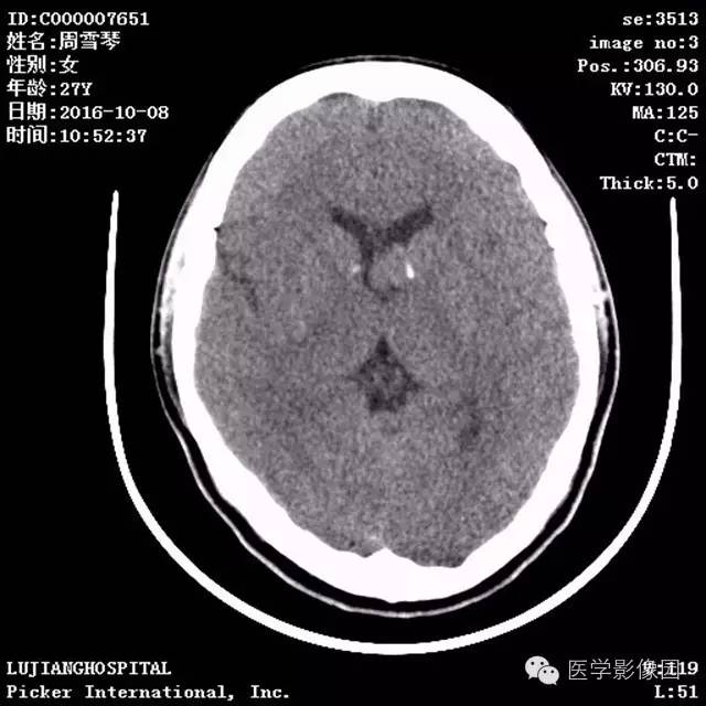 【病例】结节硬化症1例CT及MR影像表现