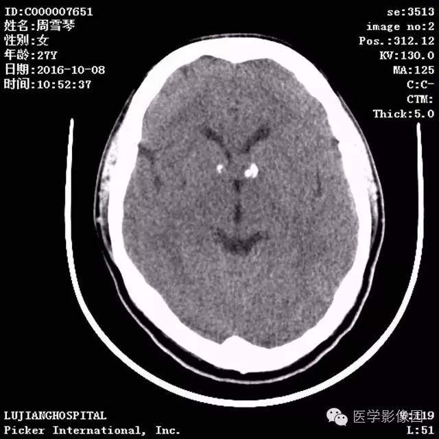 【病例】结节硬化症1例CT及MR影像表现 【病例】结节硬化症1例CT及MR影像表现