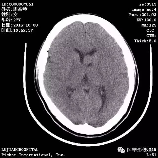 【病例】结节硬化症1例CT及MR影像表现 【病例】结节硬化症1例CT及MR影像表现
