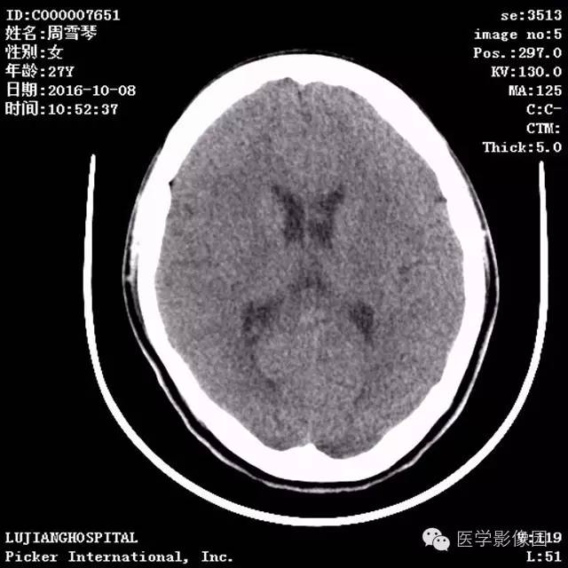 【病例】结节硬化症1例CT及MR影像表现 【病例】结节硬化症1例CT及MR影像表现