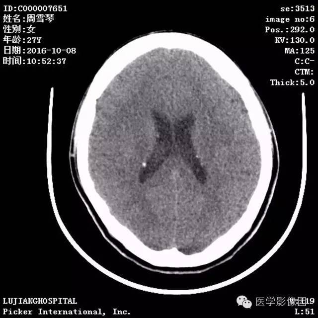 【病例】结节硬化症1例CT及MR影像表现 【病例】结节硬化症1例CT及MR影像表现